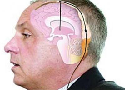 تشخیص زودهنگام پارکینسون پیش از بروز علائم