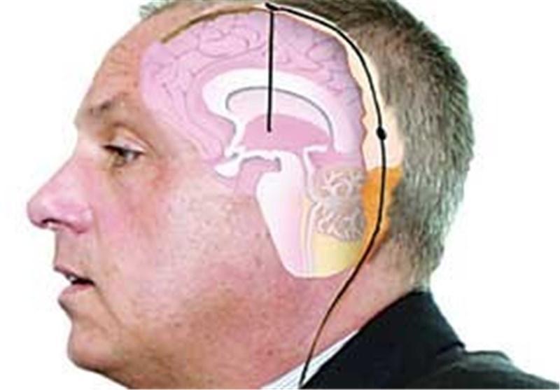 تشخیص زودهنگام پارکینسون پیش از بروز علائم تشخیص زودهنگام پارکینسون پیش از بروز علائم