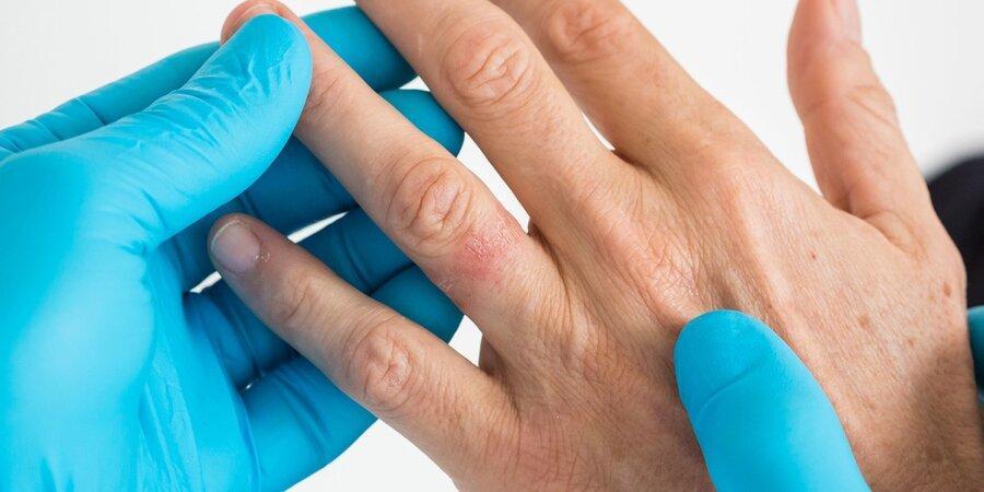 نکته بهداشتی: آلرژی به زینت آلات نکته بهداشتی: آلرژی به زینت آلات