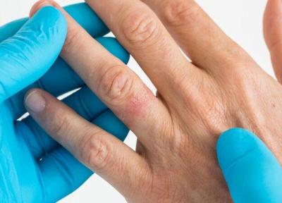 نکته بهداشتی: آلرژی به زینت آلات