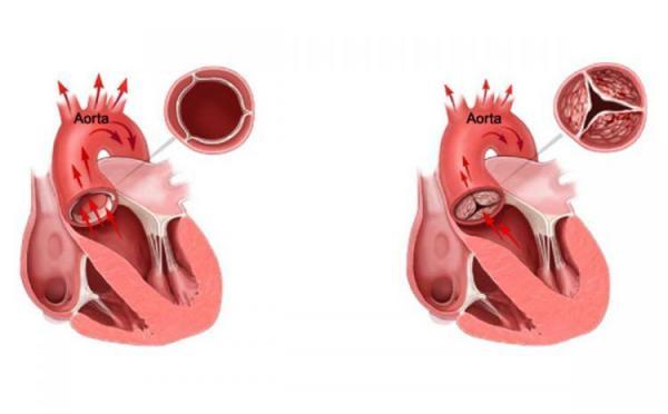 با بیماری تنگی دریچه آئورت آشنا شوید