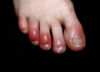 انگشت پای کوویدی؛ چیست و چرا ایجاد می گردد؟